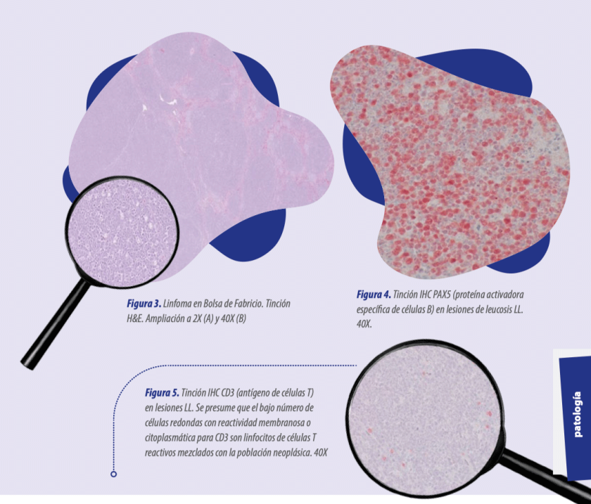 Tumores linfoides: estudio retrospectivo