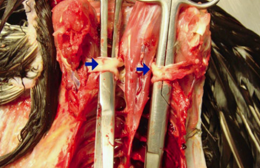 Leucose Linfoide