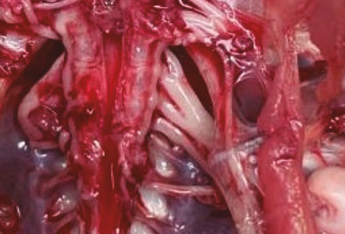 Leucose Linfoide