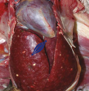 Leucose Linfoide