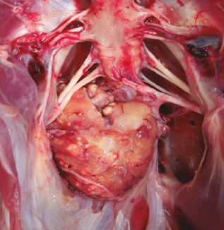 Leucose Linfoide