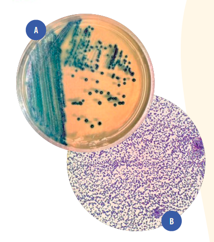 Figura 1. (a) Cultura de Enterococcus spp. em CHROMagar™. (b)Enterococcus spp. em coloração de Gram [obj.100x]. Fonte: os autores.