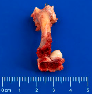 Figura 2. Condronecrose bacteriana com osteomielite em fêmur defrango de corte com isolamento de E. faecalis. Fonte: os autores.