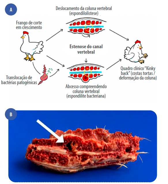 Figura 5. (a) Ilustração de estenose do canal vertebral por espondilolistese ou espondilite bacteriana. Fonte: Adaptado de Musyahadah et al., 2025.(b) Secção sagital da coluna vertebral. Abcesso comprimindo a medula espinhal (seta branca). Isolado E. faecalis da lesão. Fonte: os autores.